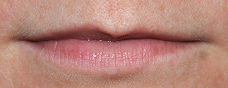 Laser Resurfacing Before & After Gallery - Patient 424384 - Image 2