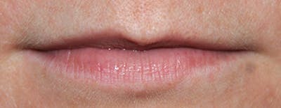 Scar Revision Before & After Gallery - Patient 379116 - Image 2