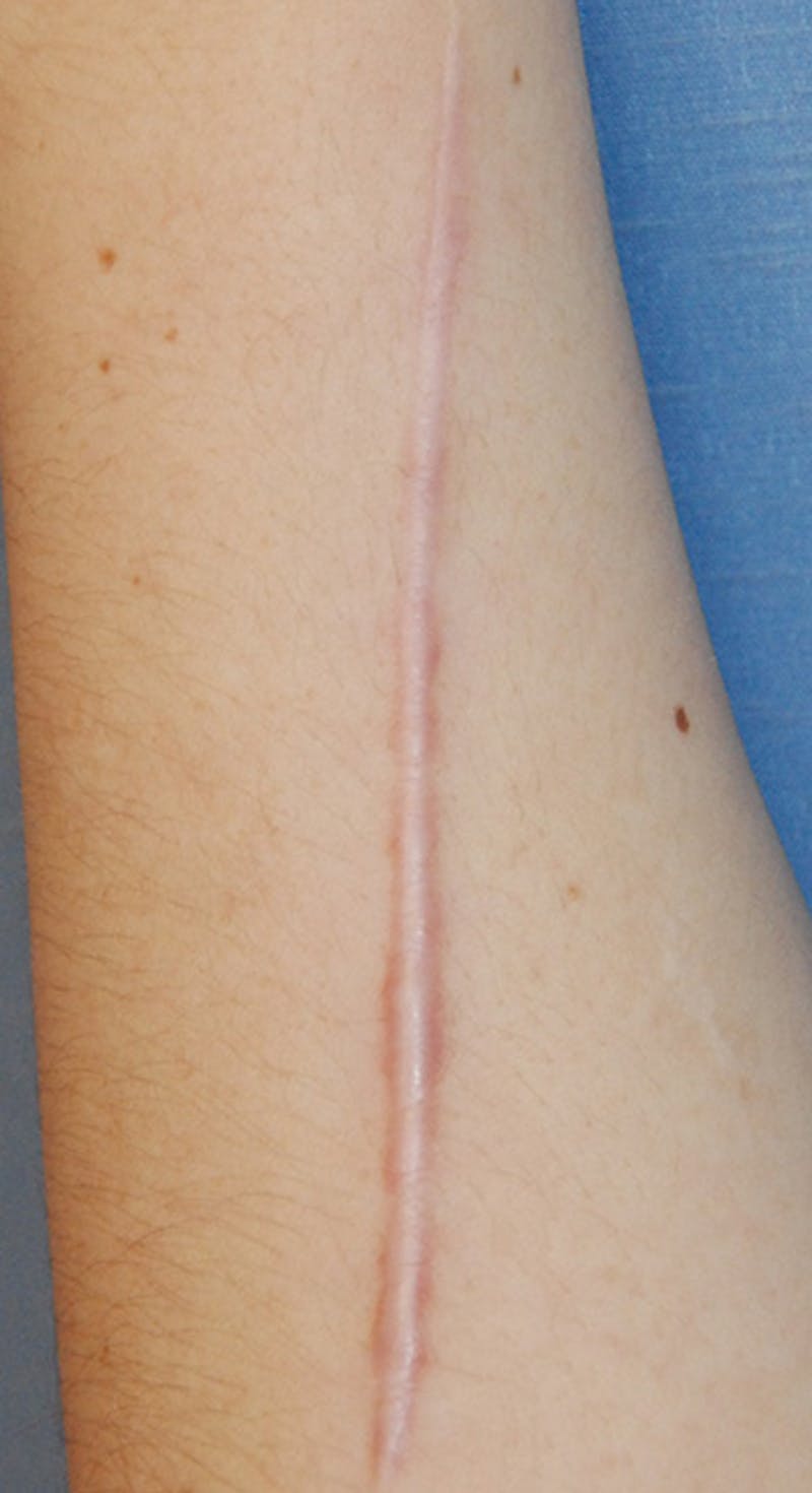 Scar Revision Before & After Gallery - Patient 196787 - Image 1