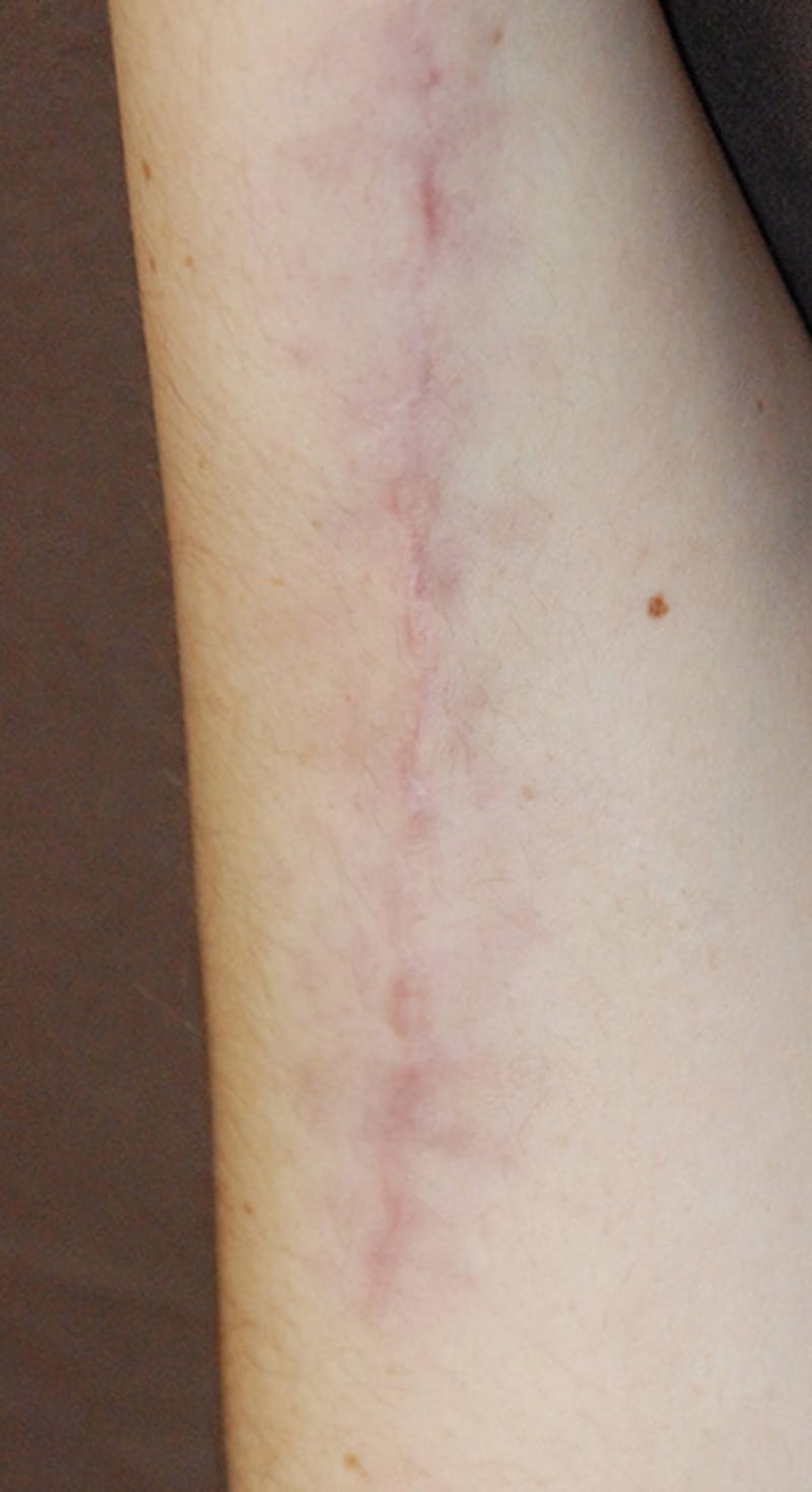 Scar Revision Before & After Gallery - Patient 196787 - Image 2