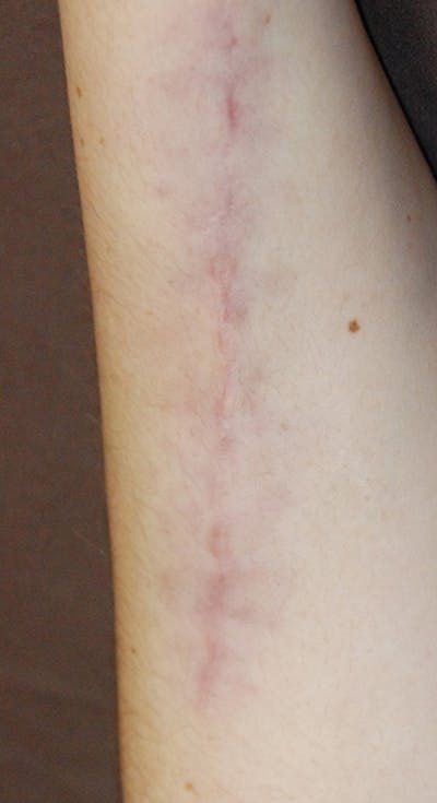 Scar Revision Before & After Gallery - Patient 196787 - Image 2