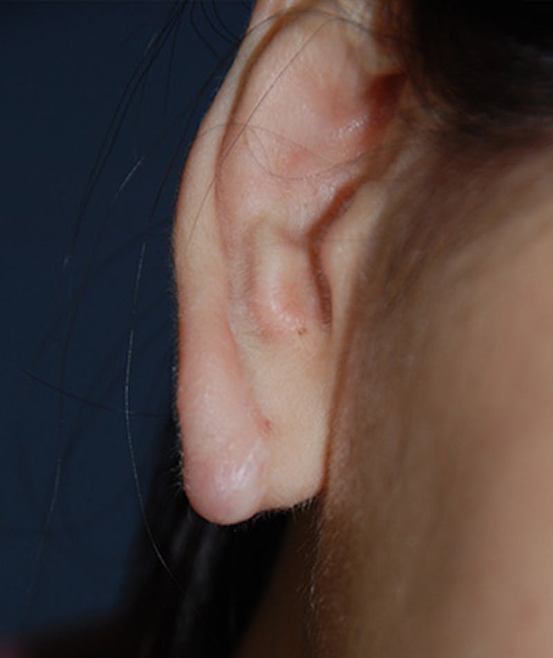 Scar Revision Before & After Gallery - Patient 186422 - Image 1
