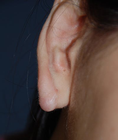 Scar Revision Before & After Gallery - Patient 186422 - Image 1
