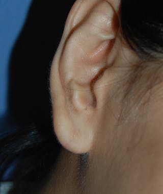 Scar Revision Before & After Gallery - Patient 186422 - Image 2