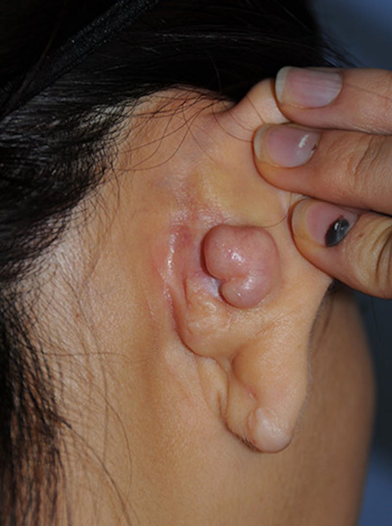 Scar Revision Before & After Gallery - Patient 186422 - Image 3