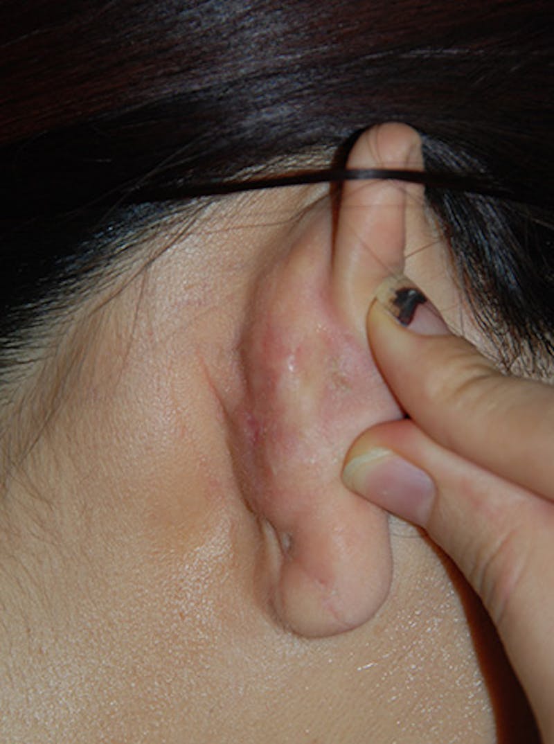 Scar Revision Before & After Gallery - Patient 186422 - Image 4