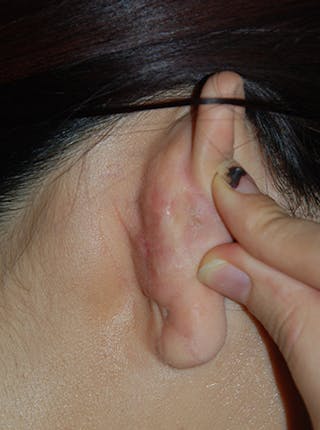 Scar Revision Before & After Gallery - Patient 186422 - Image 4