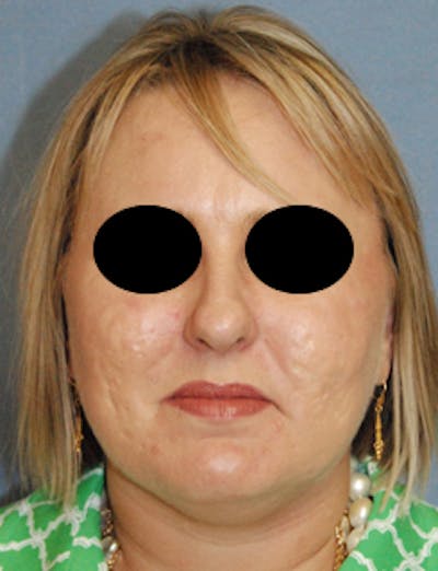 Scar Revision Before & After Gallery - Patient 139404 - Image 2