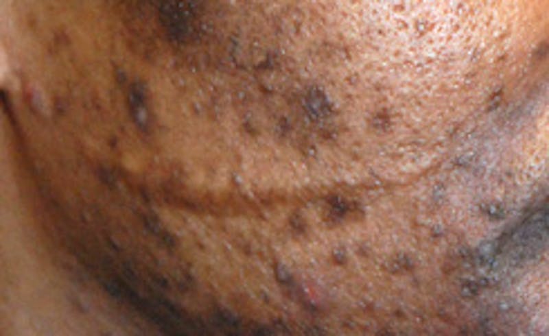 Scar Revision Before & After Gallery - Patient 345743 - Image 1