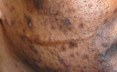 Scar Revision Before & After Gallery - Patient 345743 - Image 1