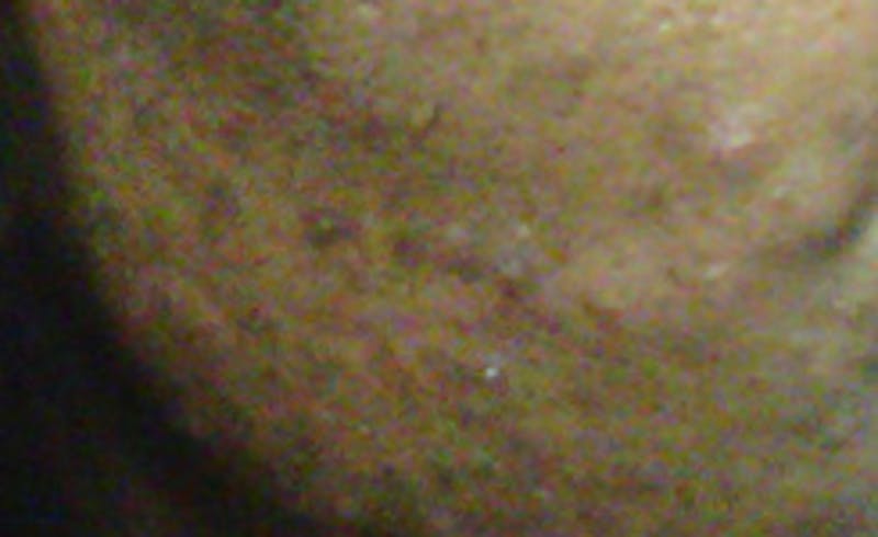Scar Revision Before & After Gallery - Patient 345743 - Image 2