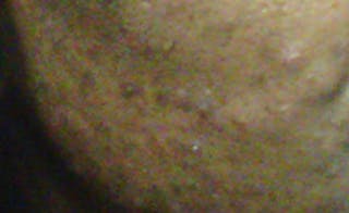 Scar Revision Before & After Gallery - Patient 345743 - Image 2