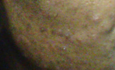 Scar Revision Before & After Gallery - Patient 345743 - Image 2