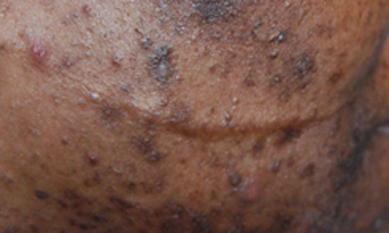 Scar Revision Before & After Gallery - Patient 345743 - Image 3