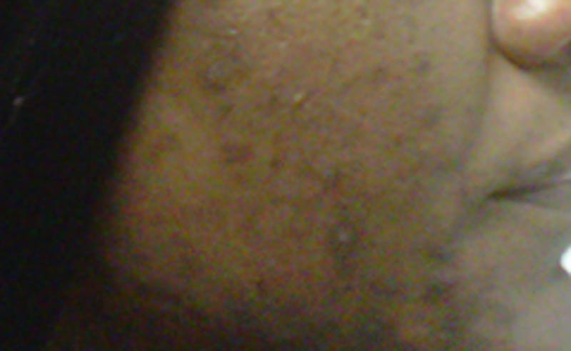 Scar Revision Before & After Gallery - Patient 345743 - Image 4