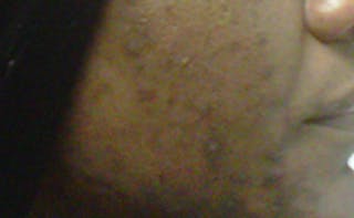 Scar Revision Before & After Gallery - Patient 345743 - Image 4