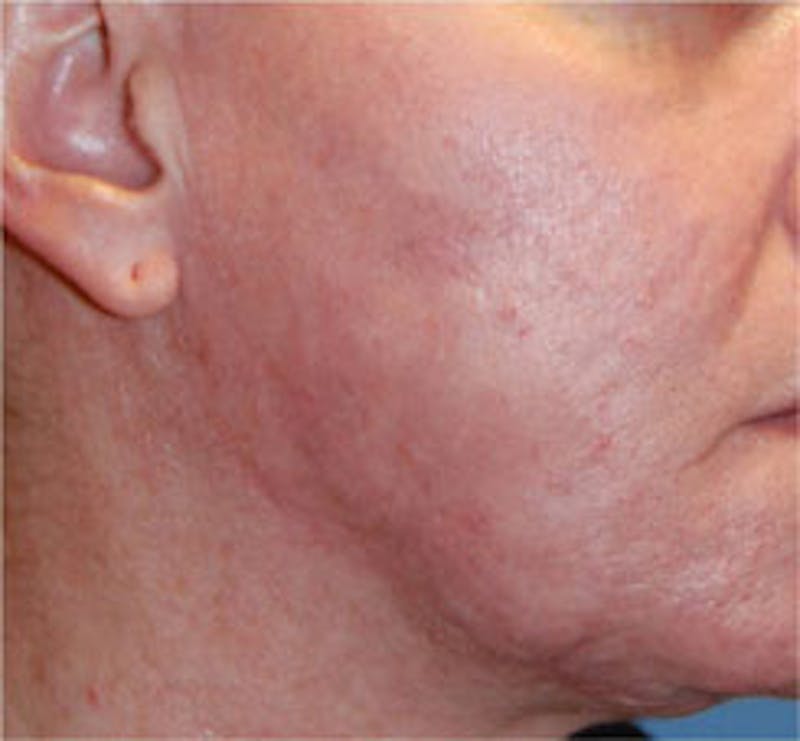 Scar Revision Before & After Gallery - Patient 428116 - Image 6
