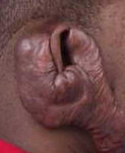 Scar Revision Before & After Gallery - Patient 102716 - Image 1