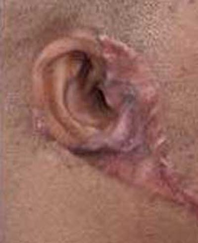 Scar Revision Before & After Gallery - Patient 102716 - Image 2