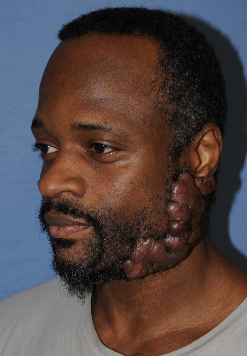 Scar Revision Before & After Gallery - Patient 237717 - Image 1