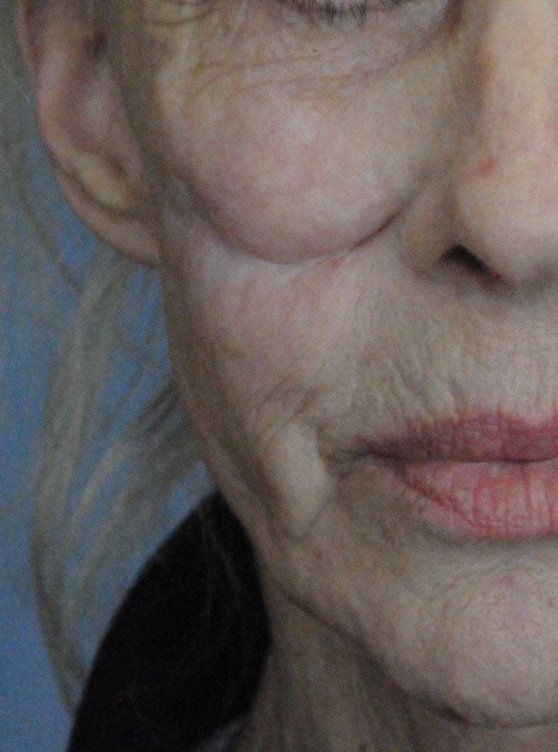 Scar Revision Before & After Gallery - Patient 236355 - Image 1