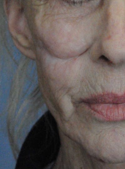 Scar Revision Before & After Gallery - Patient 236355 - Image 1