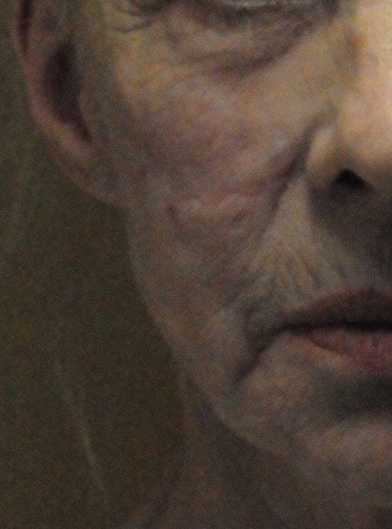 Scar Revision Before & After Gallery - Patient 236355 - Image 2