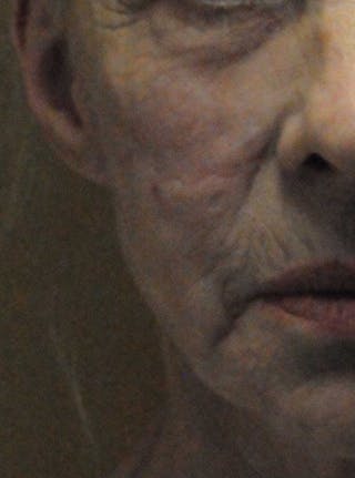 Scar Revision Before & After Gallery - Patient 236355 - Image 2