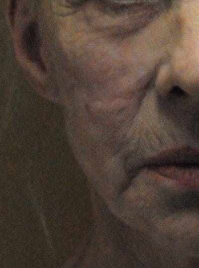 Scar Revision Before & After Gallery - Patient 236355 - Image 2