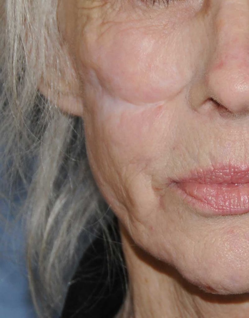 Scar Revision Before & After Gallery - Patient 236355 - Image 3