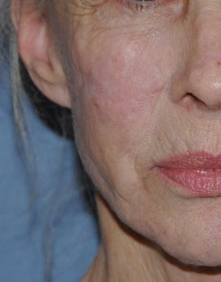 Scar Revision Before & After Gallery - Patient 236355 - Image 4