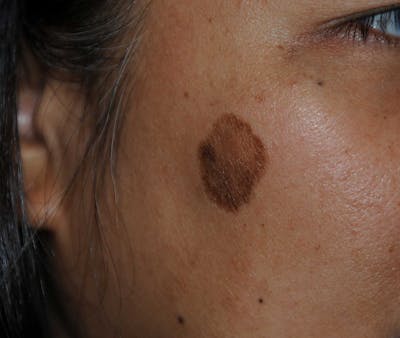 Skin Lesion & Mole Removal Before & After Gallery - Patient 186366 - Image 1