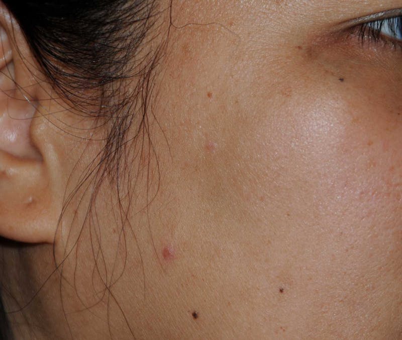 Skin Lesion & Mole Removal Before & After Gallery - Patient 186366 - Image 2