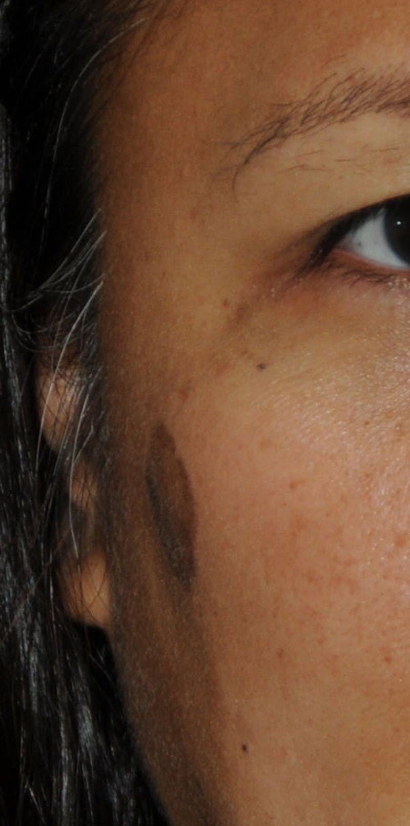 Skin Lesion & Mole Removal Before & After Gallery - Patient 186366 - Image 3