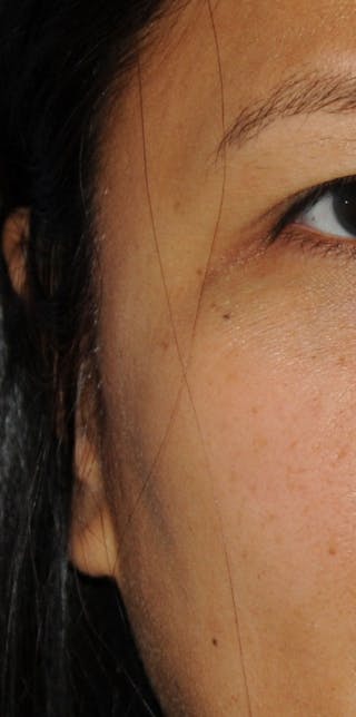 Skin Lesion & Mole Removal Before & After Gallery - Patient 186366 - Image 4
