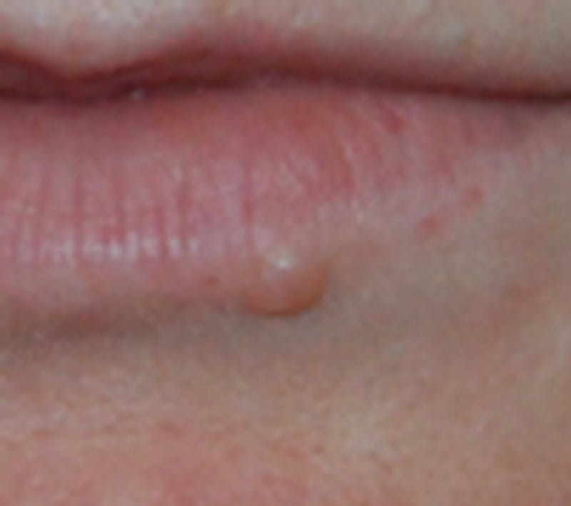 Skin Lesion & Mole Removal Before & After Gallery - Patient 258359 - Image 1