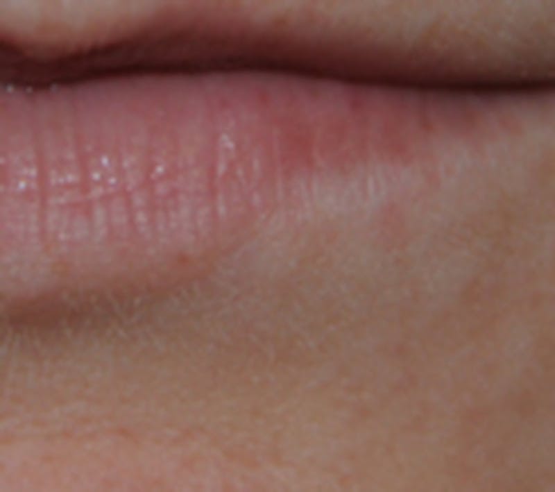 Skin Lesion & Mole Removal Before & After Gallery - Patient 258359 - Image 2