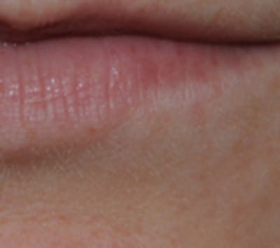 Skin Lesion & Mole Removal Before & After Gallery - Patient 258359 - Image 2
