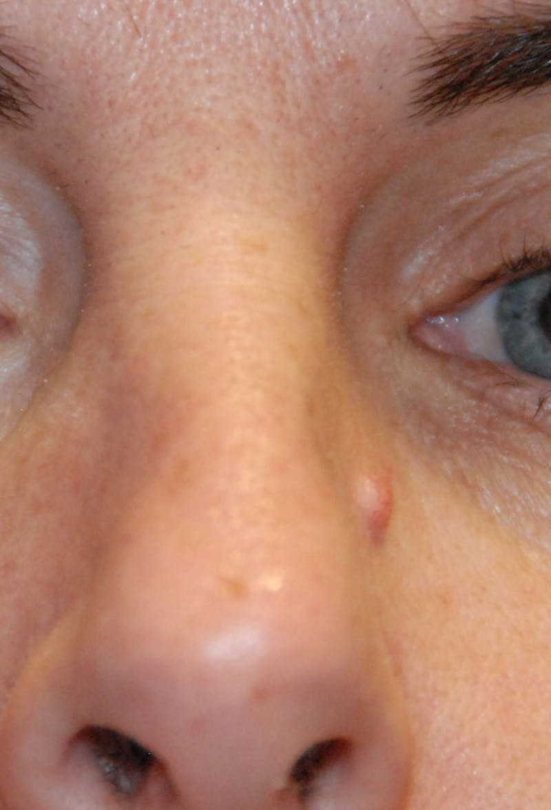 Skin Lesion & Mole Removal Before & After Gallery - Patient 259532 - Image 1