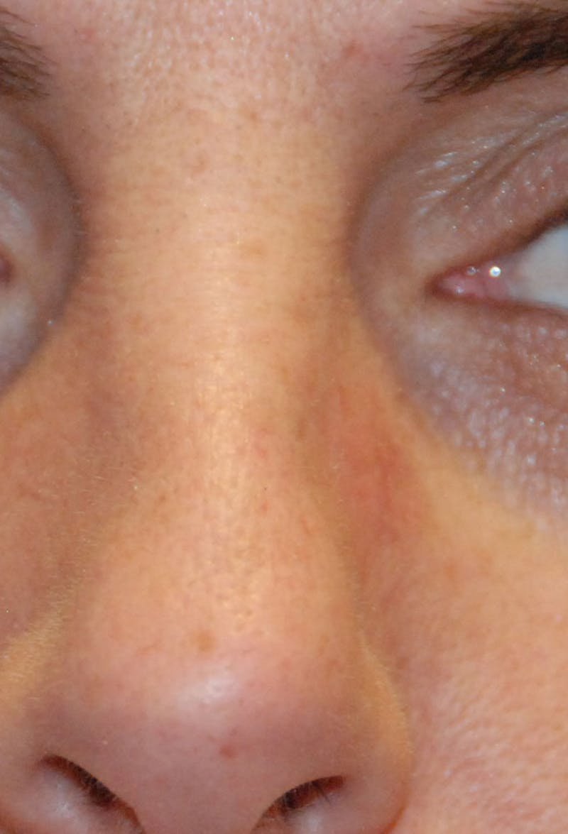 Skin Lesion & Mole Removal Before & After Gallery - Patient 259532 - Image 2