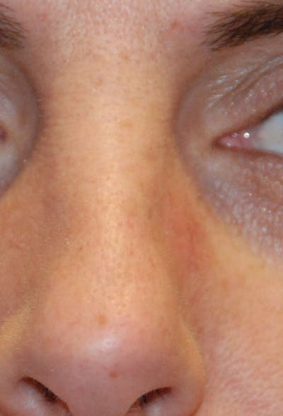 Skin Lesion & Mole Removal Before & After Gallery - Patient 259532 - Image 2
