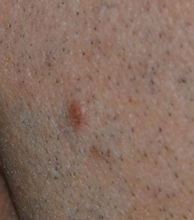 Skin Lesion & Mole Removal Before & After Gallery - Patient 410919 - Image 1