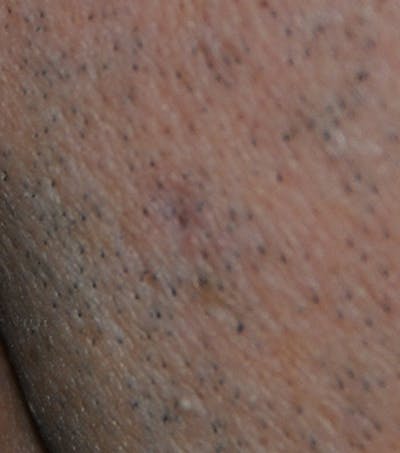 Skin Lesion & Mole Removal Before & After Gallery - Patient 410919 - Image 2
