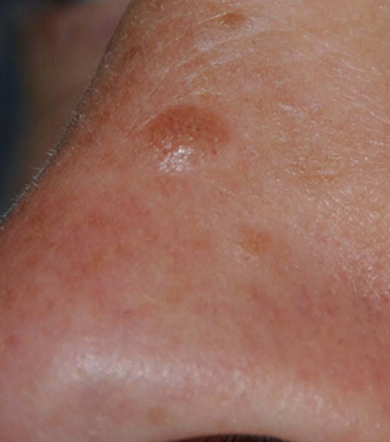 Skin Lesion & Mole Removal Before & After Gallery - Patient 302792 - Image 1