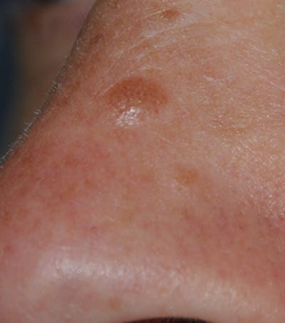 Skin Lesion & Mole Removal Before & After Gallery - Patient 302792 - Image 1