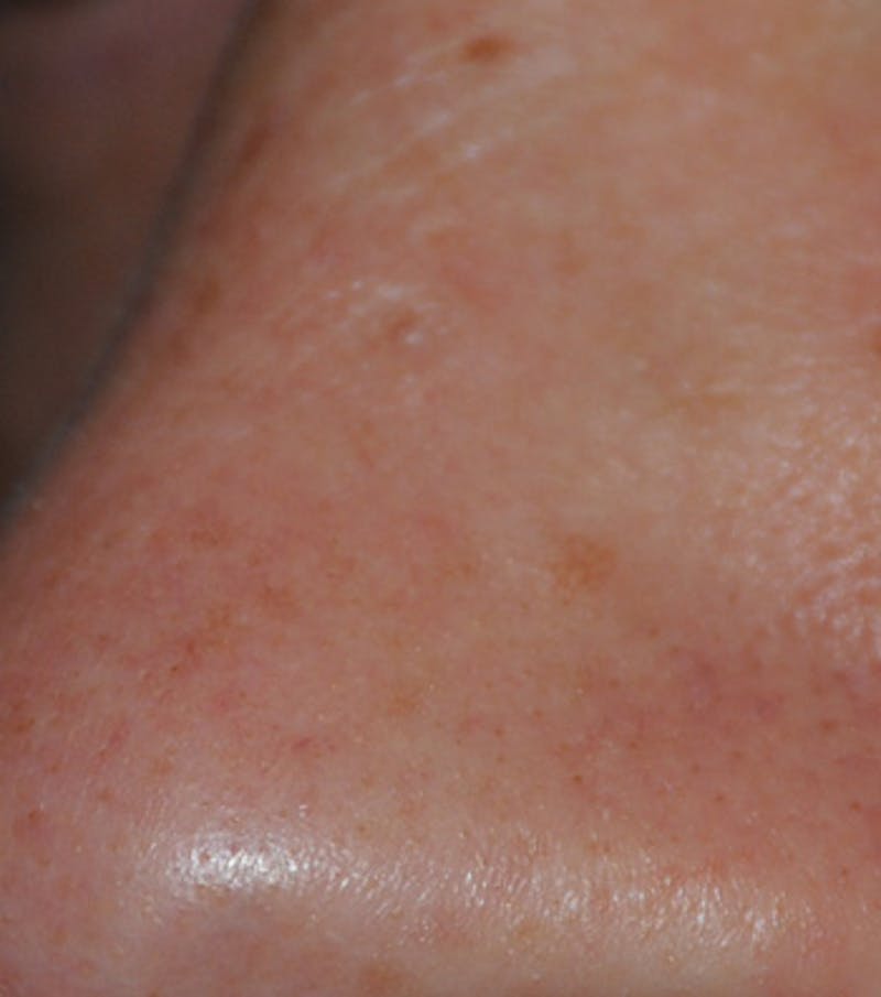 Skin Lesion & Mole Removal Before & After Gallery - Patient 302792 - Image 2