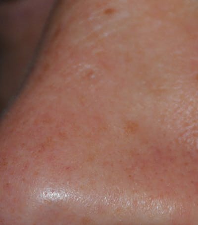 Skin Lesion & Mole Removal Before & After Gallery - Patient 302792 - Image 2