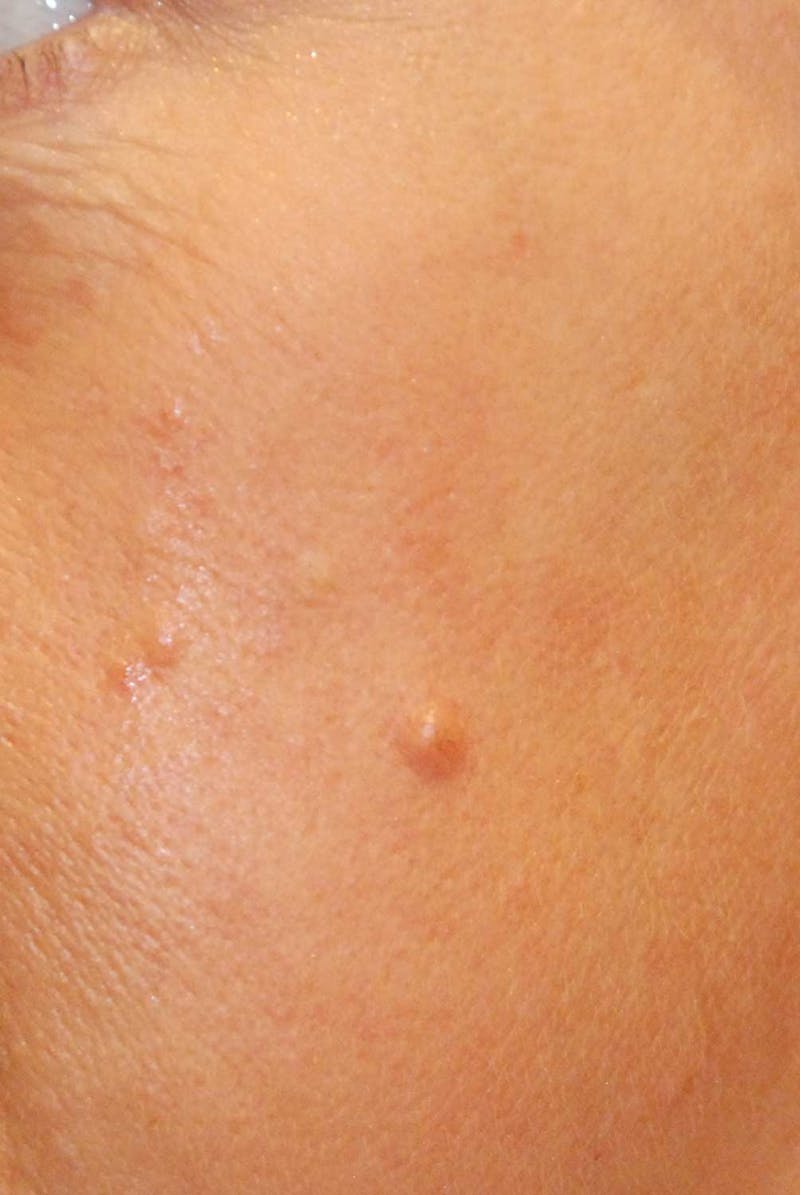 Skin Lesion & Mole Removal Before & After Gallery - Patient 293156 - Image 1
