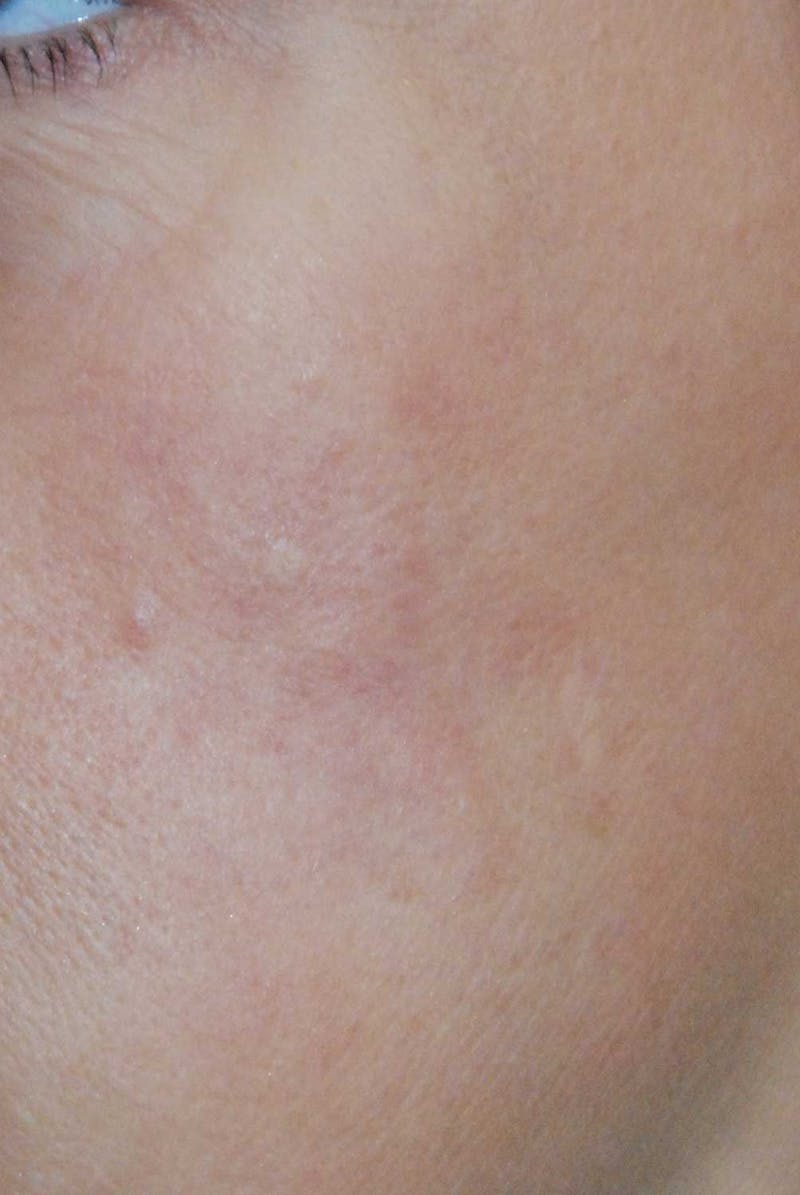 Skin Lesion & Mole Removal Before & After Gallery - Patient 293156 - Image 2