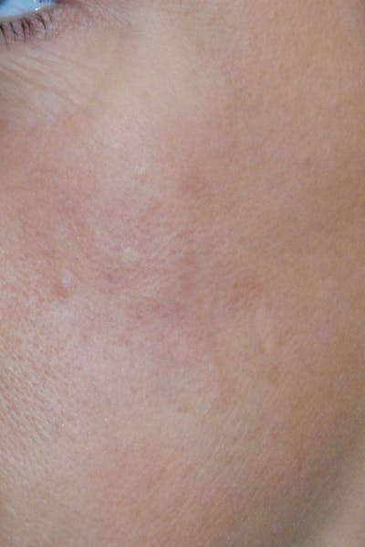 Skin Lesion & Mole Removal Before & After Gallery - Patient 293156 - Image 2